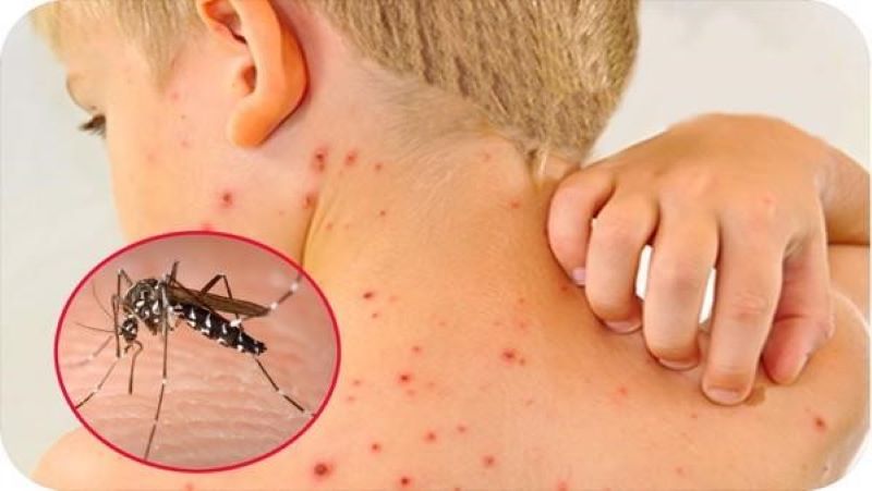 Muỗi vằn Aedes aegypti - Thủ phạm hàng đầu gây sốt xuất huyết ở trẻ nhỏ.