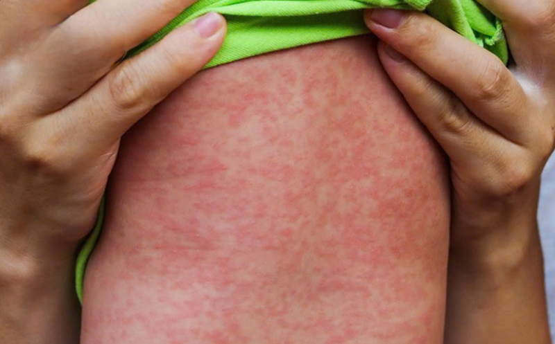 Phát ban đặc trưng của bệnh sởi thường xuất hiện theo thứ tự từ đầu đến chân.