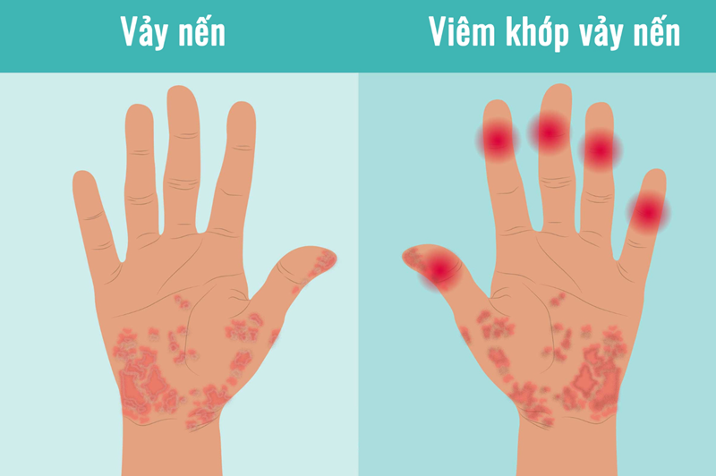 Viêm khớp vảy nến gây sưng đau các khớp, cần được điều trị sớm để tránh nguy cơ tàn phế.